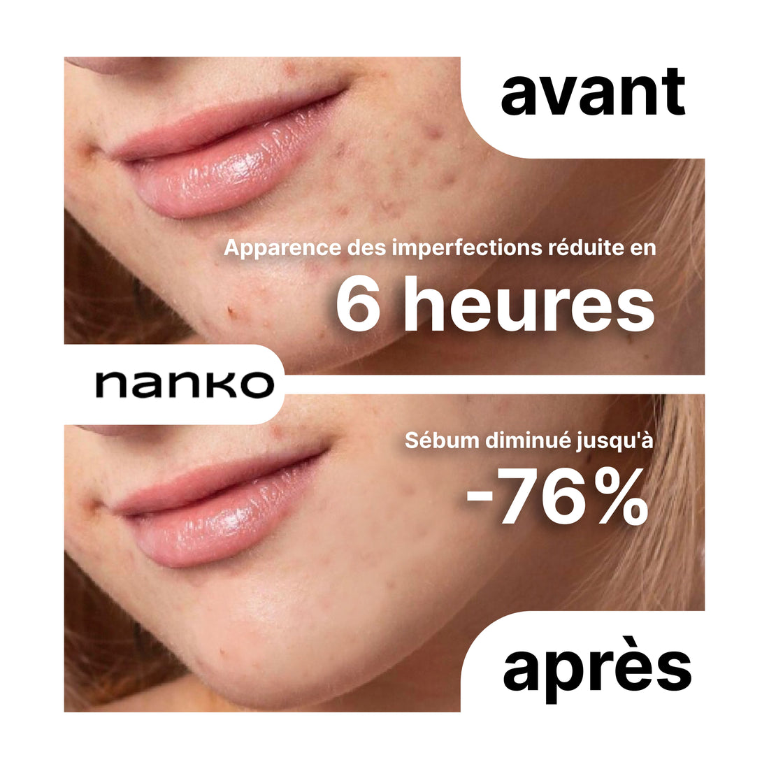 Stick Acnélift